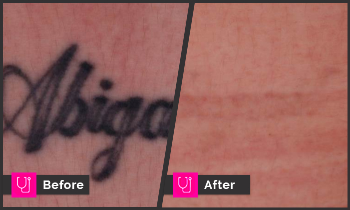 Picoway Tattoo Removal