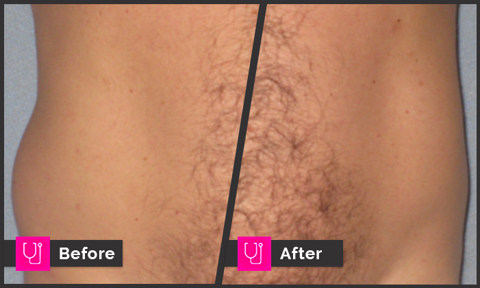 Untreated / Treated CoolSculpting