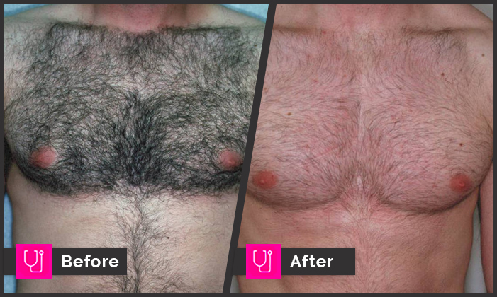 Hair-removal Chest