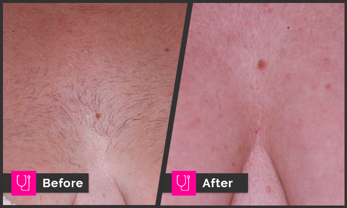 Woman Chest Hair Removal