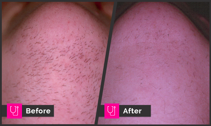 Woman Neck Hair Removal