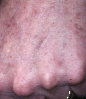 Revlite Laser For Freckles and Brown Spots in NJ